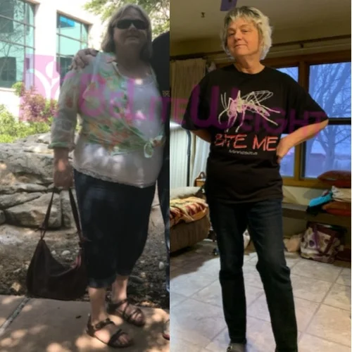 Weight Loss Surgery Before and After Cheryl H